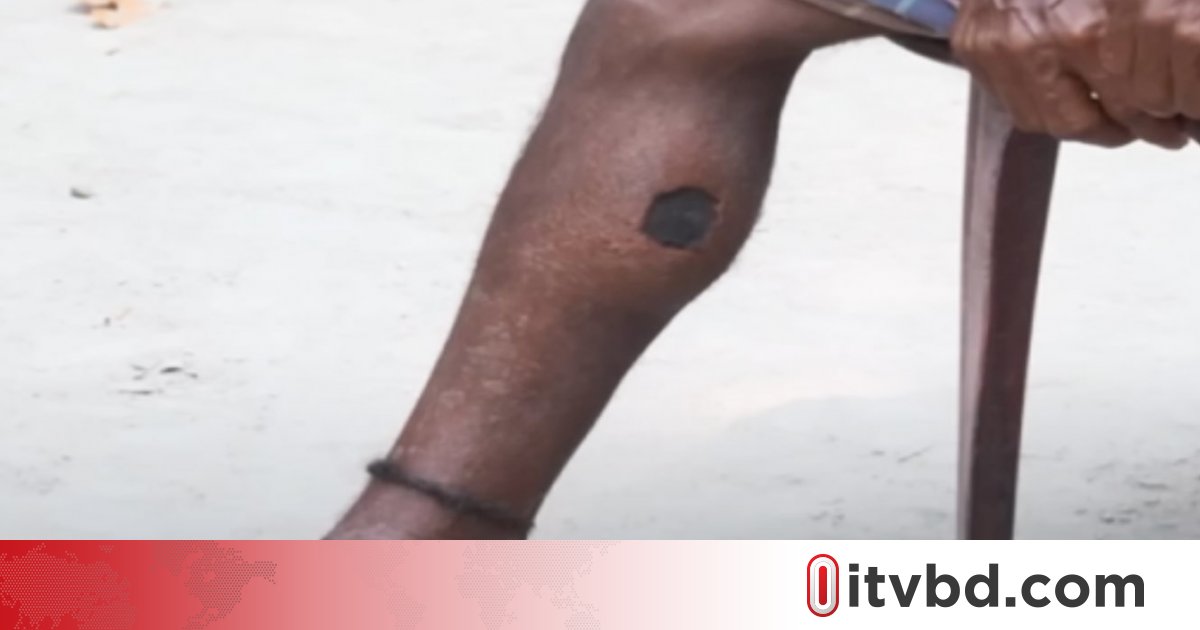 অ্যানথ্রাক্স কী, কীভাবে ছড়ায়?