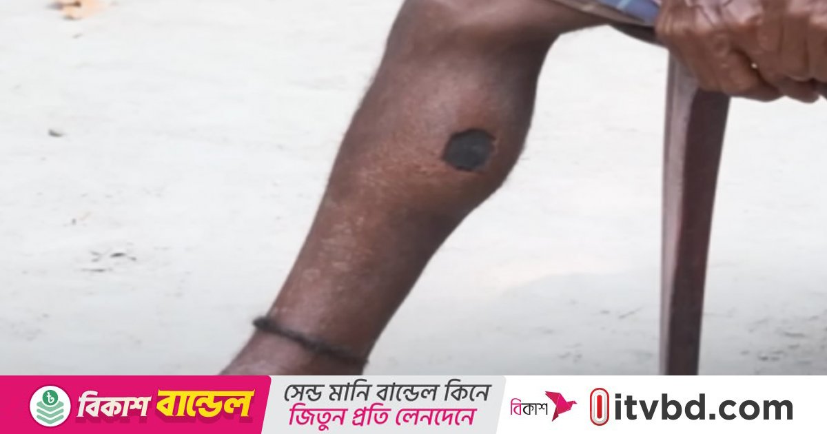 রংপুরে ২ মাসে অ্যানথ্রাক্সে শতাধিক গরুর মৃত্যু, আক্রান্ত অর্ধশতাধিক মানুষ