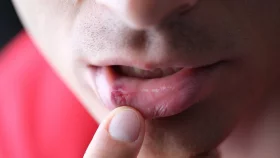 যেভাবে মুখের ঘা নিরাময় করবেন
