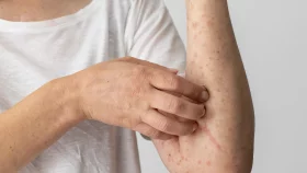 স্ক্যাবিস কি ছোঁয়াচে? এ রোগ কীভাবে ছড়ায়