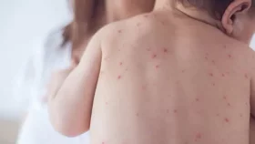শিশুকে হাম থেকে বাঁচাতে যা করবেন