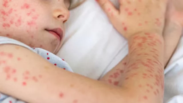 হামের টিকা নিয়ে গুজব ও থুতু মালিশের পরামর্শ, বাংলাদেশে বাড়ছে উদ্বেগ